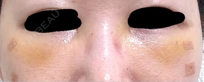 クマ治療 / 下まぶたの脂肪取り / 脂肪注入（目の下） 吉井クリニック DAY 4 メイン用