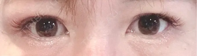 二重埋没 / 上まぶたの脂肪取り 恵聖会クリニック 梅田院 DAY 14 メイン用