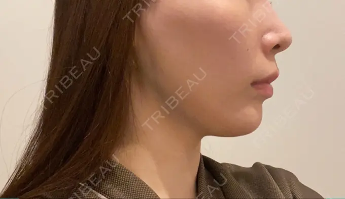 糸リフト / 脂肪吸引（顔） / ボトックス（エラ・小顔） RIVER CLINIC（リバークリニック） DAY 0 メイン用