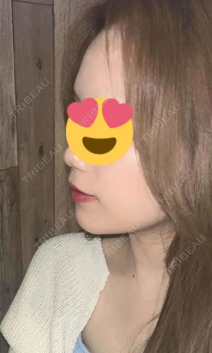 糸リフト / ヒアルロン酸注入（あご） / ボトックス（肩） TCB東京中央美容外科 心斎橋院 AFTER メイン用