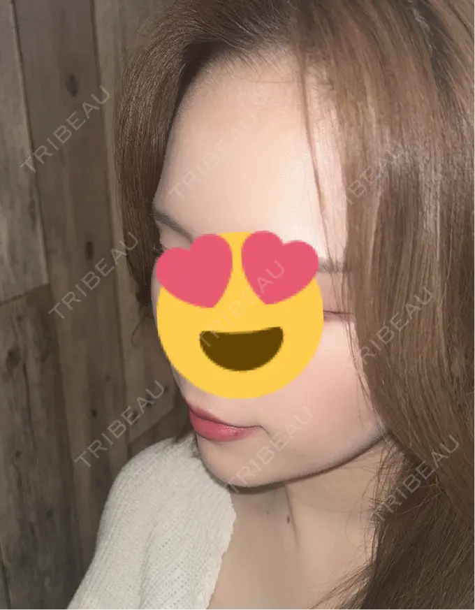 糸リフト / ヒアルロン酸注入（あご） / ボトックス（肩） TCB東京中央美容外科 心斎橋院 DAY 31 メイン用