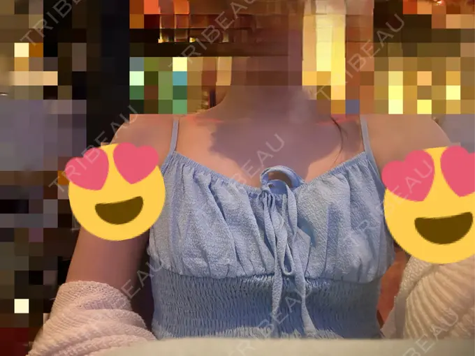 糸リフト / ヒアルロン酸注入（あご） / ボトックス（肩） TCB東京中央美容外科 心斎橋院 DAY 31 メイン用