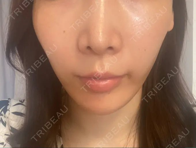 糸リフト / 脂肪吸引（顔） / ボトックス（エラ・小顔） RIVER CLINIC（リバークリニック） DAY 1 メイン用