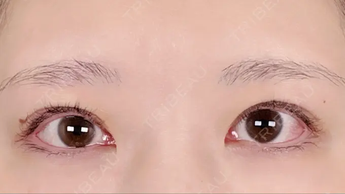 眼瞼下垂（非切開） SOL CLINIC DAY 0 メイン用