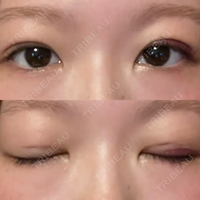 二重埋没 水の森美容クリニック 東京銀座院 DAY 4 メイン用