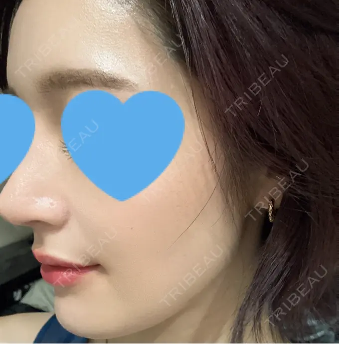 ヒアルロン酸注入（鼻翼基部） DMTC CLINIC 日本橋院 DAY 0 メイン用