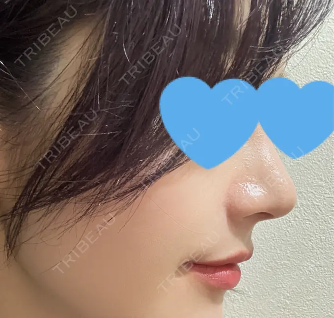 ヒアルロン酸注入（鼻翼基部） DMTC CLINIC 日本橋院 DAY 0 メイン用