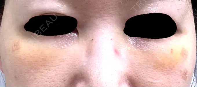 クマ治療 / 下まぶたの脂肪取り / 脂肪注入（目の下） 吉井クリニック DAY 5 メイン用