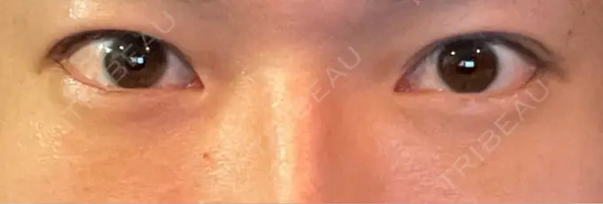 クマ治療 ROOTS Clinic AFTER メイン用