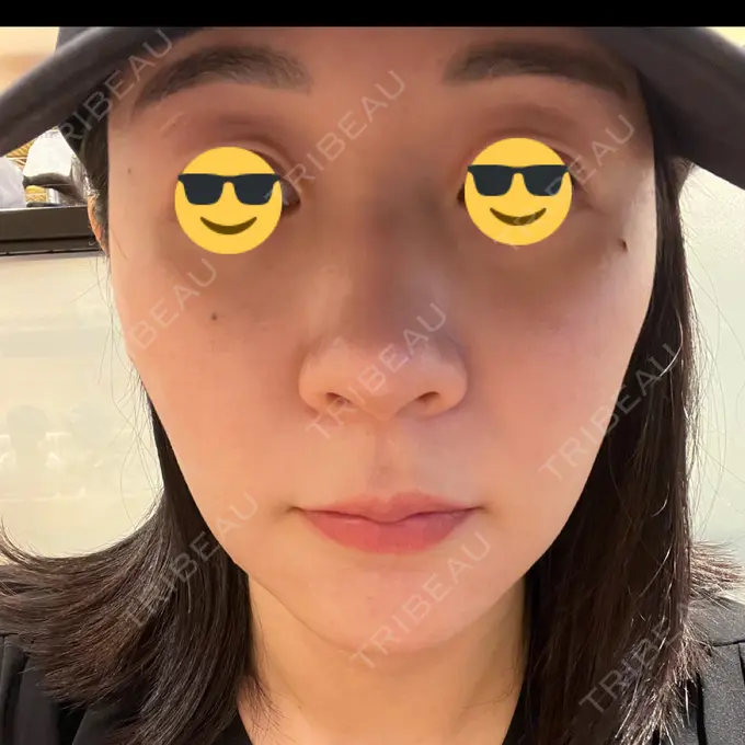 ニードルRF（ポテンツァなど） / ポテンツァ Tokyo Tensei Clinic 銀座院 DAY 2 メイン用