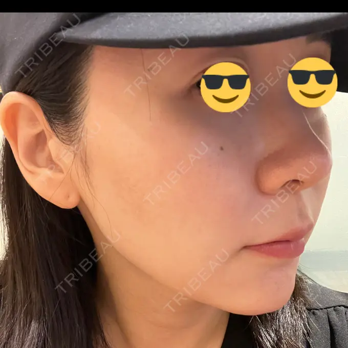 ニードルRF（ポテンツァなど） / ポテンツァ Tokyo Tensei Clinic 銀座院 DAY 2 メイン用