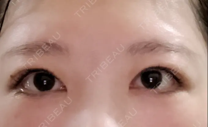 眼瞼下垂（非切開） SOL CLINIC DAY 1 メイン用