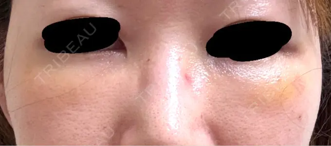 クマ治療 / 下まぶたの脂肪取り / 脂肪注入（目の下） 吉井クリニック DAY 6 メイン用