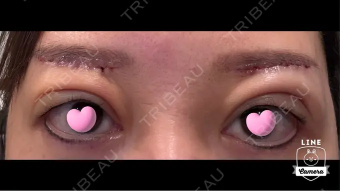 眉下切開 ルーチェクリニック 銀座院 DAY 2 メイン用