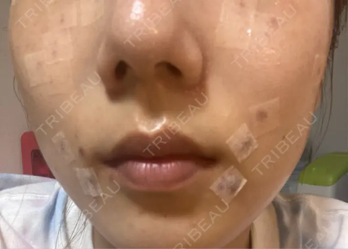 シミ取りレーザー S-Laboクリニック 渋谷院 DAY 0 メイン用