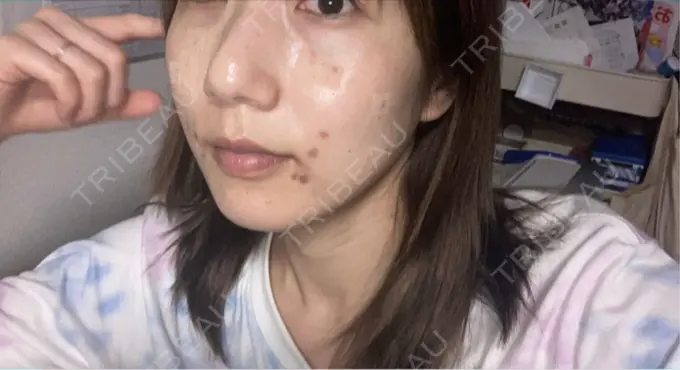 シミ取りレーザー S-Laboクリニック 渋谷院 DAY 0 メイン用