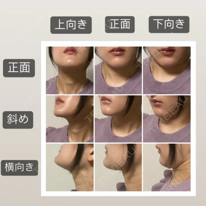 脂肪吸引（顔） 湘南美容クリニック 秋葉原院 DAY 70 メイン用