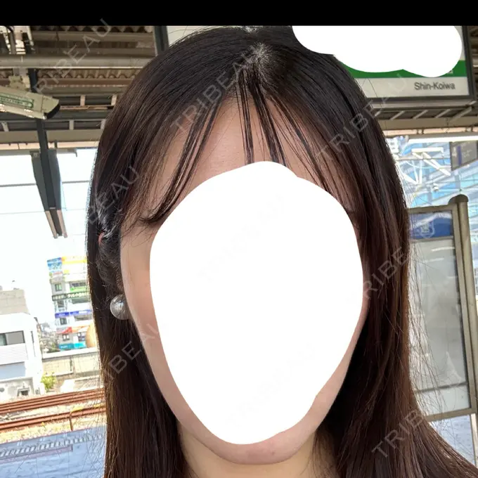 糸リフト / 脂肪吸引（顔） / ボトックス（エラ・小顔） RIVER CLINIC（リバークリニック） AFTER メイン用