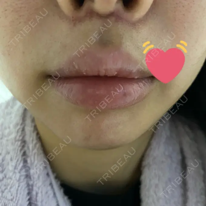 人中短縮 / ボトックス（人中） 新宿ラクル美容外科クリニック 新宿院 DAY 35 メイン用