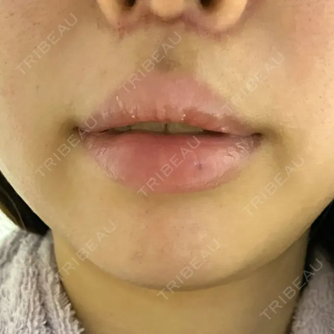 人中短縮 / ボトックス（人中） 新宿ラクル美容外科クリニック 新宿院 DAY 35 メイン用