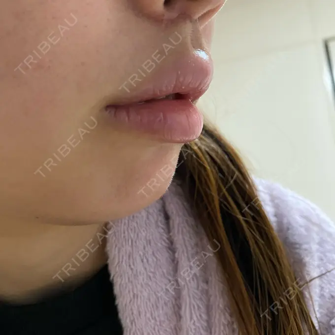 人中短縮 / ボトックス（人中） 新宿ラクル美容外科クリニック 新宿院 DAY 35 メイン用