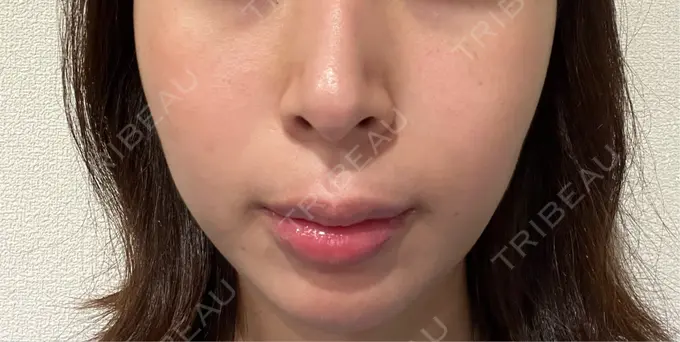 肌ヒアルロン酸注入（たるみ・シワ改善） / 水光注射（ハリ・美肌） シェリークリニック 福岡院 AFTER メイン用