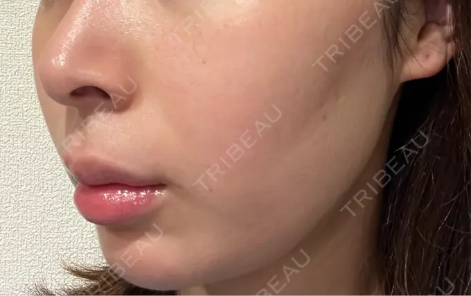 肌ヒアルロン酸注入（たるみ・シワ改善） / 水光注射（ハリ・美肌） シェリークリニック 福岡院 DAY 8 メイン用