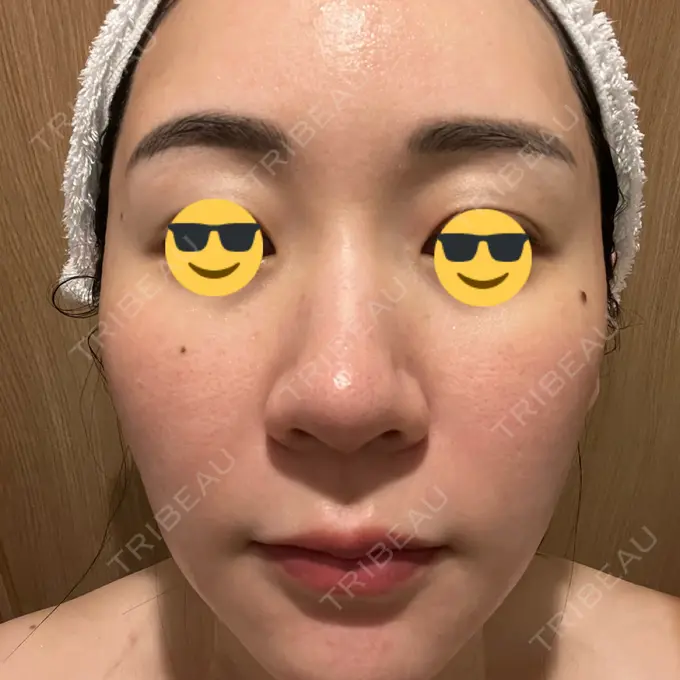 ニードルRF（ポテンツァなど） / ポテンツァ Tokyo Tensei Clinic 銀座院 DAY 2 メイン用