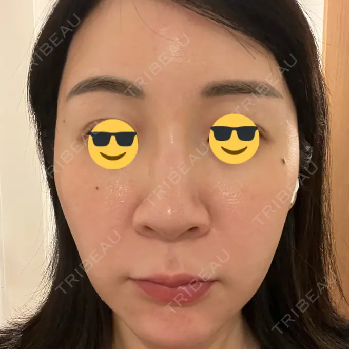 ニードルRF（ポテンツァなど） / ポテンツァ Tokyo Tensei Clinic 銀座院 DAY 3 メイン用