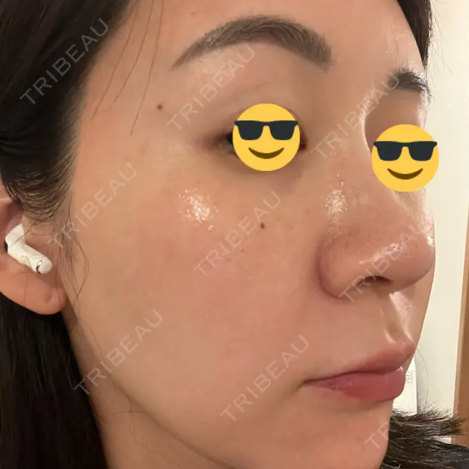 ニードルRF（ポテンツァなど） / ポテンツァ Tokyo Tensei Clinic 銀座院 DAY 3 メイン用