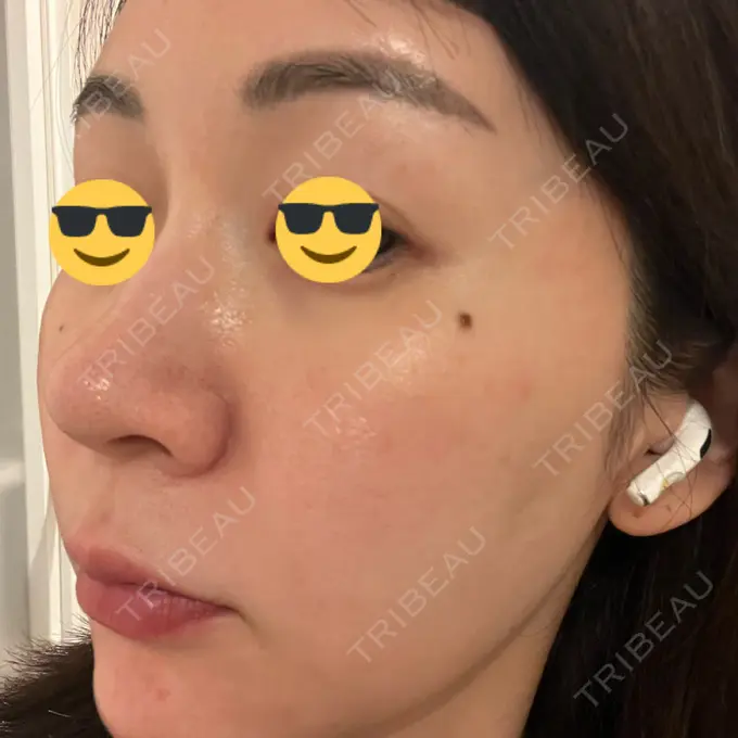 ニードルRF（ポテンツァなど） / ポテンツァ Tokyo Tensei Clinic 銀座院 DAY 3 メイン用