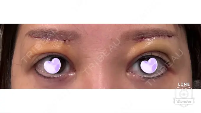 眉下切開 ルーチェクリニック 銀座院 DAY 3 メイン用