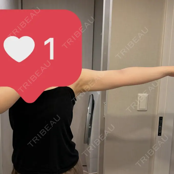 脂肪吸引（二の腕） Mods Clinic（モッズクリニック） 福岡院 AFTER メイン用