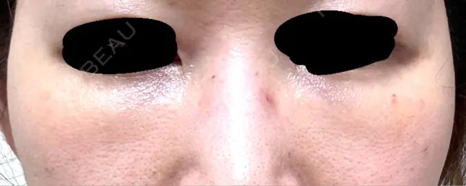 クマ治療 / 下まぶたの脂肪取り / 脂肪注入（目の下） 吉井クリニック DAY 8 メイン用