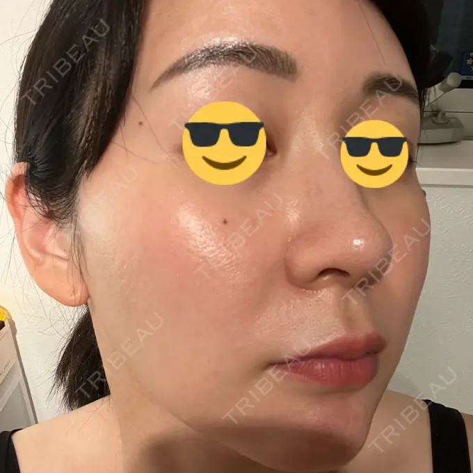 ニードルRF（ポテンツァなど） / ポテンツァ Tokyo Tensei Clinic 銀座院 DAY 4 メイン用