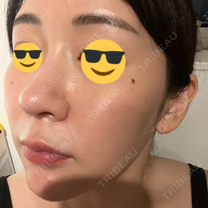 ニードルRF（ポテンツァなど） / ポテンツァ Tokyo Tensei Clinic 銀座院 DAY 4 メイン用