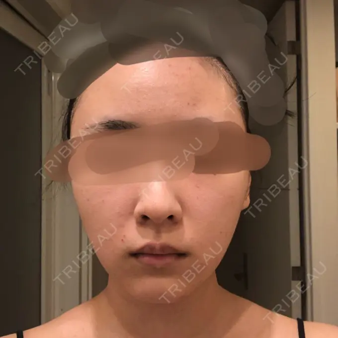 バッカルファット除去 / 脂肪吸引（顔） / ヒアルロン酸注入（鼻） / ボトックス（あご） / 水光注射（ハリ・美肌） / ボトックス（エラ・小顔） / ボトックス（口角） / 白玉点滴・注射 エートップ美容整形外科 DAY 22 メイン用