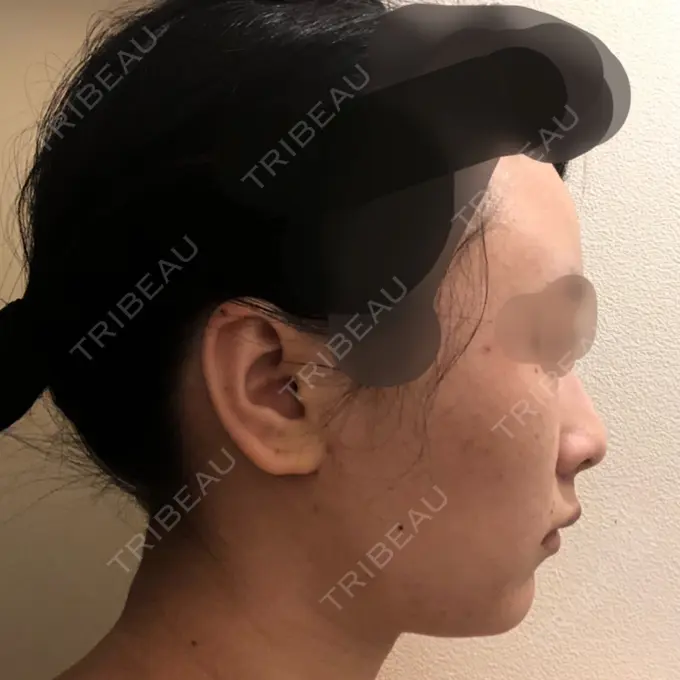 バッカルファット除去 / 脂肪吸引（顔） / ヒアルロン酸注入（鼻） / ボトックス（あご） / 水光注射（ハリ・美肌） / ボトックス（エラ・小顔） / ボトックス（口角） / 白玉点滴・注射 エートップ美容整形外科 DAY 22 メイン用