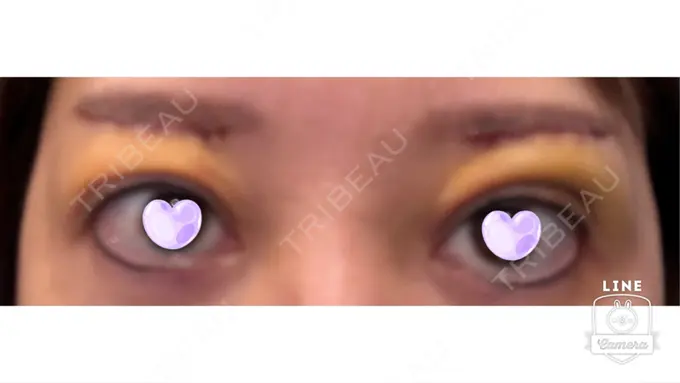 眉下切開 ルーチェクリニック 銀座院 DAY 4 メイン用