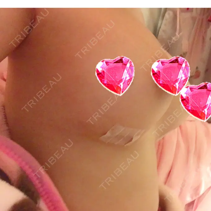 豊胸（シリコンバッグ） ナグモクリニック 東京院 DAY 3 メイン用