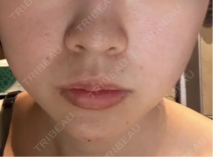 ヒアルロン酸注入（涙袋） / ヒアルロン酸注入（あご） / ボトックス（エラ・小顔） RIVER CLINIC（リバークリニック） DAY 0 メイン用