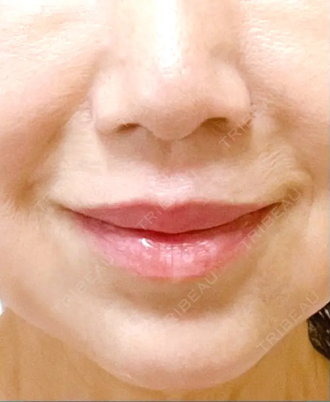 小鼻縮小（切開） / 人中短縮 Otus Clinic 【オータスクリニック】 DAY 430 メイン用