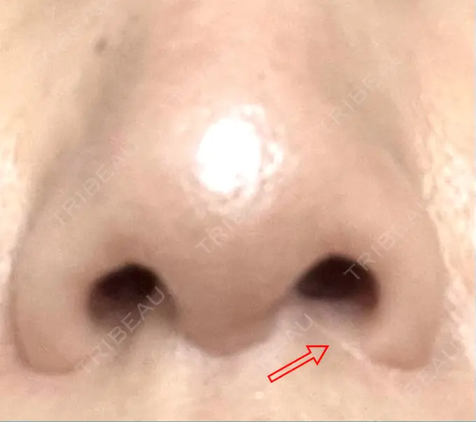 小鼻縮小（切開） / 人中短縮 Otus Clinic 【オータスクリニック】 DAY 430 メイン用