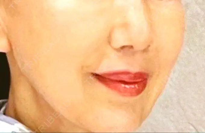 小鼻縮小（切開） / 人中短縮 Otus Clinic 【オータスクリニック】 DAY 430 メイン用