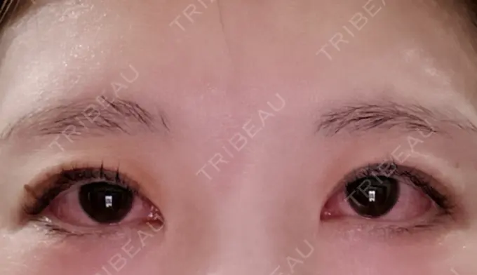 眼瞼下垂（非切開） SOL CLINIC DAY 4 メイン用