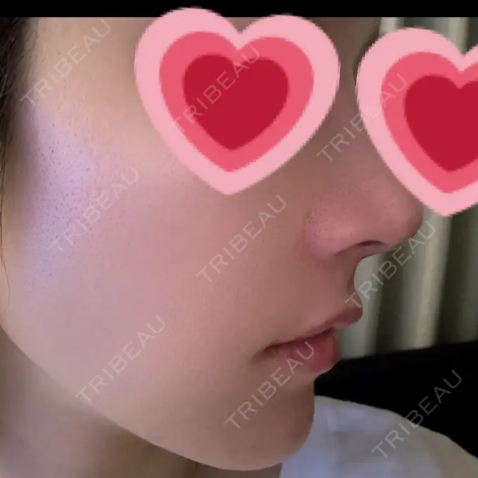 ヒアルロン酸注入（鼻翼基部） DMTC CLINIC 日本橋院 DAY 4 メイン用