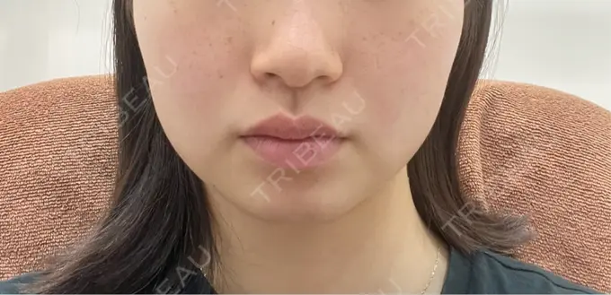 RF（高周波）たるみ治療 ライブリークリニック 浜松町院 AFTER メイン用