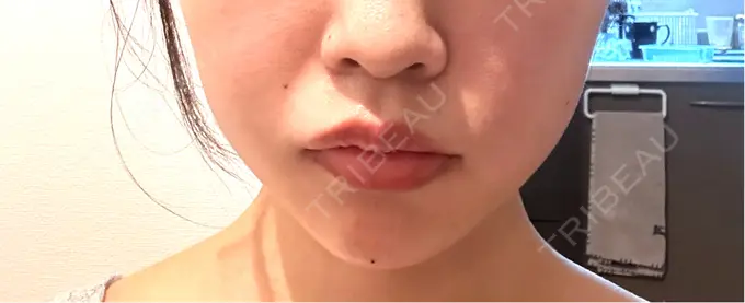 ヒアルロン酸注入（涙袋） / ヒアルロン酸注入（あご） / ボトックス（エラ・小顔） RIVER CLINIC（リバークリニック） DAY 1 メイン用