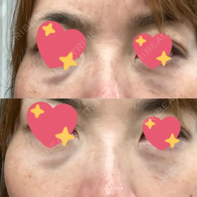 クマ治療 東京形成美容外科 船橋院 DAY 0 メイン用