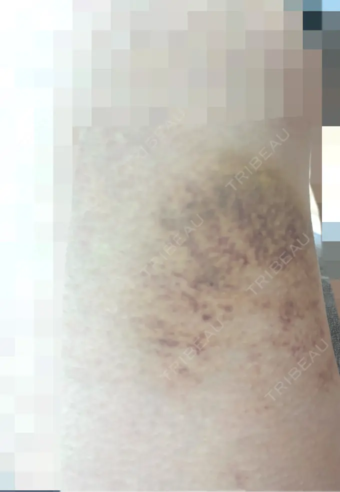 クマ治療 / 下まぶたの脂肪取り / 脂肪注入（目の下） 吉井クリニック DAY 10 メイン用